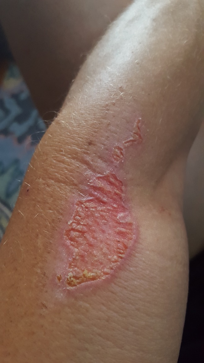 arm